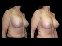 Breast Before After Photos Breast Implant Replacement Before After Photos Case #13594 - Pancholi Cosmetic Surgery