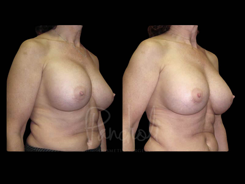 Breast Before After Photos Breast Implant Replacement Before After Photos Case #13594 - Pancholi Cosmetic Surgery