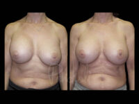 Breast Before After Photos Breast Implant Replacement Before After Photos Case #13595 - Pancholi Cosmetic Surgery