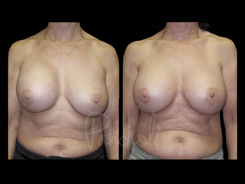 Breast Before After Photos Breast Implant Replacement Before After Photos Case #13595 - Pancholi Cosmetic Surgery