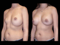 Breast Before After Photos Breast Implant Replacement Before After Photos Case #13597 - Pancholi Cosmetic Surgery