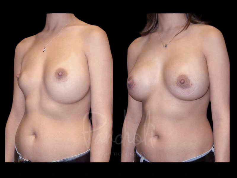 Breast Before After Photos Breast Implant Replacement Before After Photos Case #13597 - Pancholi Cosmetic Surgery