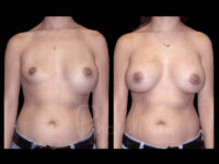 Breast Before After Photos Breast Implant Replacement Before After Photos Case #13598 - Pancholi Cosmetic Surgery
