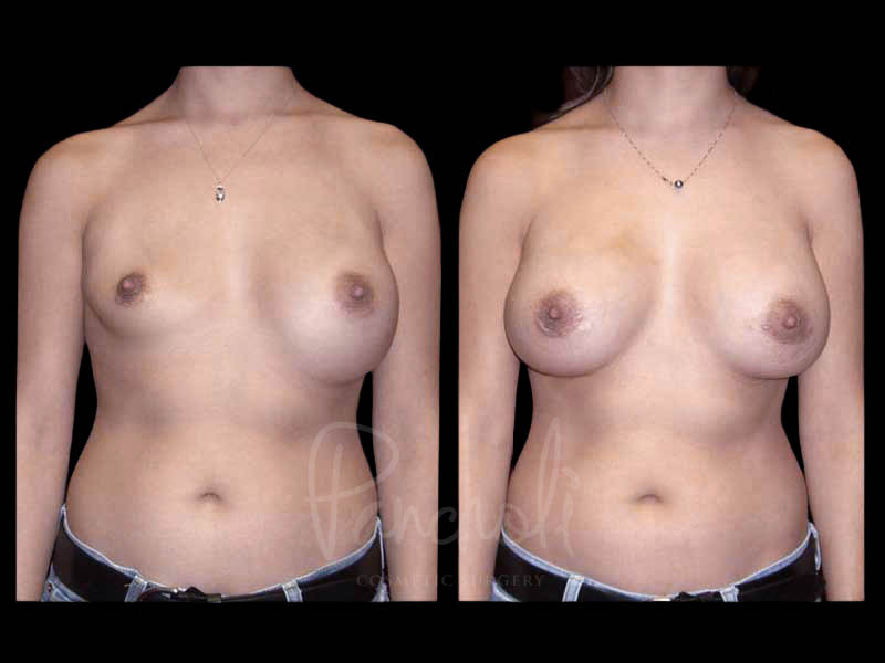 Breast Before After Photos Breast Implant Replacement Before After Photos Case #13598 - Pancholi Cosmetic Surgery