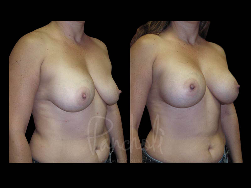 Breast Before After Photos Breast Implant Replacement Before After Photos Case #13600 - Pancholi Cosmetic Surgery