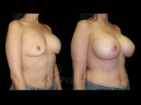 Breast Before After Photos Breast Implant Replacement Before After Photos Case #13603 - Pancholi Cosmetic Surgery