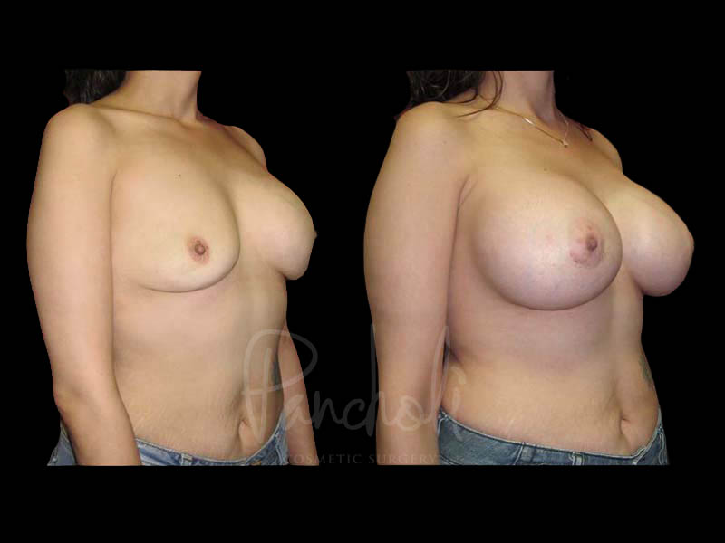Breast Before After Photos Breast Implant Replacement Before After Photos Case #13603 - Pancholi Cosmetic Surgery