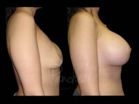 Breast Before After Photos Breast Implant Replacement Before After Photos Case #13604 - Pancholi Cosmetic Surgery