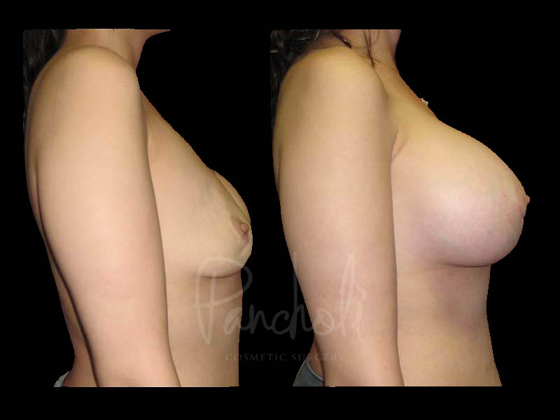 Breast Before After Photos Breast Implant Replacement Before After Photos Case #13604 - Pancholi Cosmetic Surgery