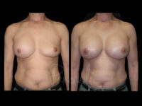 Breast Before After Photos Breast Implant Replacement Before After Photos Case #13606 - Pancholi Cosmetic Surgery