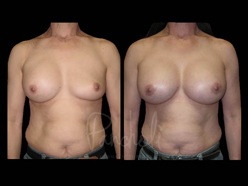 Breast Before After Photos Breast Implant Replacement Before After Photos Case #13606 - Pancholi Cosmetic Surgery