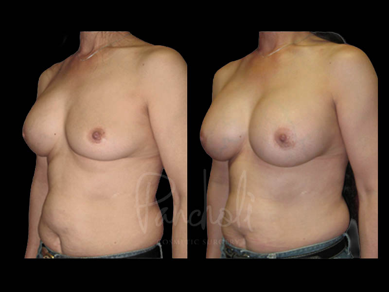 Breast Before After Photos Breast Implant Replacement Before After Photos Case #13607 - Pancholi Cosmetic Surgery