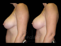 Breast Before After Photos Breast Implant Replacement Before After Photos Case #13613 - Pancholi Cosmetic Surgery