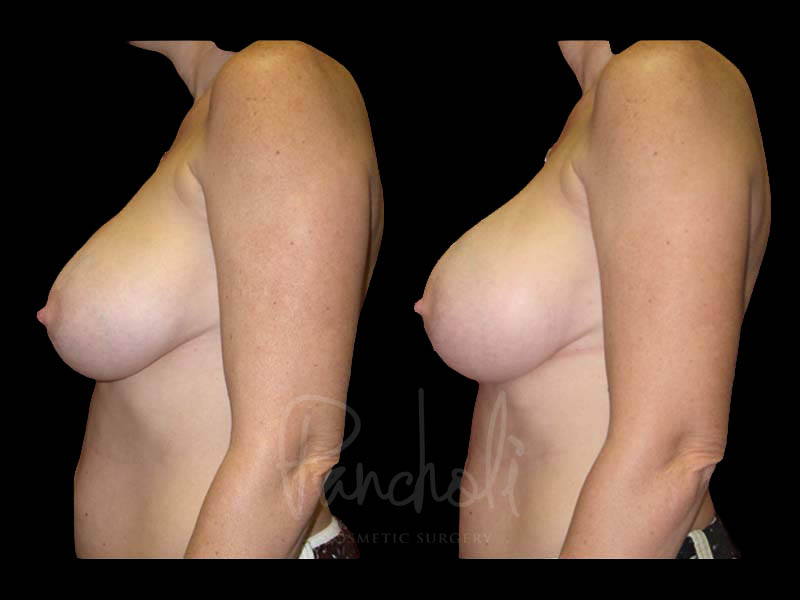 Breast Before After Photos Breast Implant Replacement Before After Photos Case #13613 - Pancholi Cosmetic Surgery