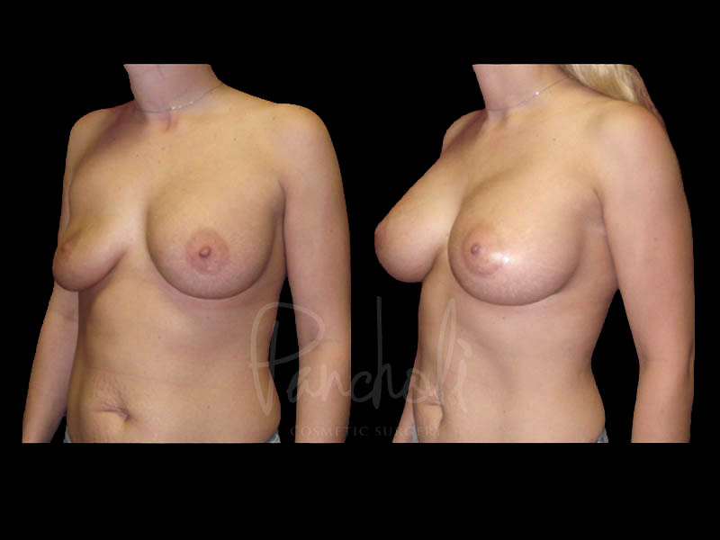 Breast Before After Photos Breast Implant Replacement Before After Photos Case #13615 - Pancholi Cosmetic Surgery