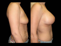 Breast Before After Photos Breast Implant Replacement Before After Photos Case #13616 - Pancholi Cosmetic Surgery