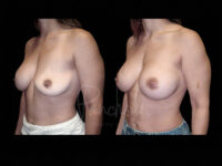 Breast Before After Photos Breast Implant Replacement Before After Photos Case #13619 - Pancholi Cosmetic Surgery