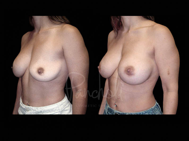 Breast Before After Photos Breast Implant Replacement Before After Photos Case #13619 - Pancholi Cosmetic Surgery