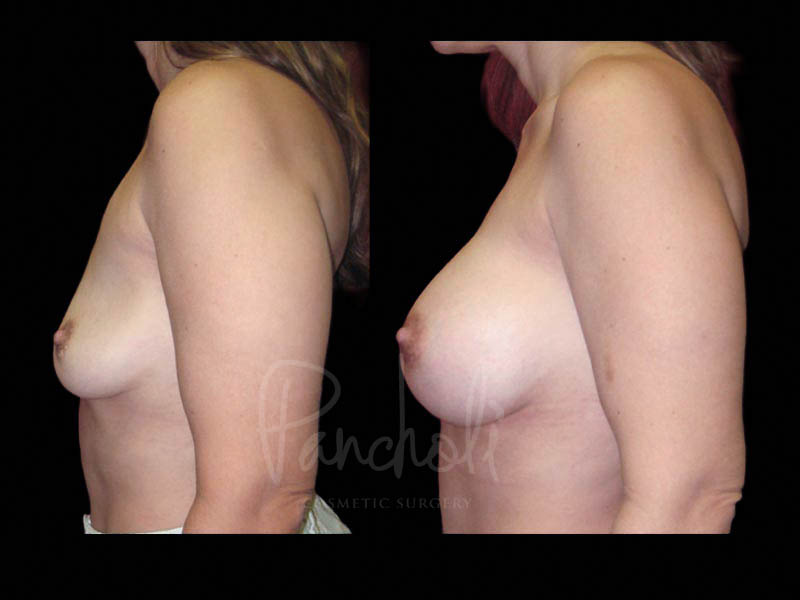 Breast Before After Photos Breast Implant Replacement Before After Photos Case #13620 - Pancholi Cosmetic Surgery