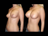 Breast Before After Photos Breast Implant Replacement Before After Photos Case #13622 - Pancholi Cosmetic Surgery