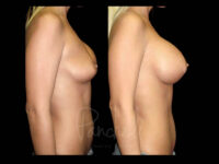 Breast Before After Photos Breast Implant Replacement Before After Photos Case #13623 - Pancholi Cosmetic Surgery