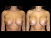Breast Before After Photos Breast Implant Replacement Before After Photos Case #13625 - Pancholi Cosmetic Surgery