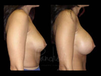 Breast Before After Photos Breast Implant Replacement Before After Photos Case #13626 - Pancholi Cosmetic Surgery