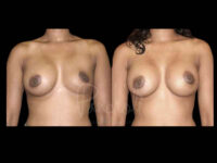 Breast Before After Photos Breast Implant Replacement Before After Photos Case #13628 - Pancholi Cosmetic Surgery