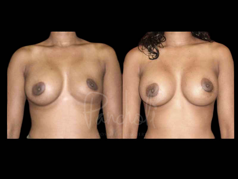 Breast Before After Photos Breast Implant Replacement Before After Photos Case #13628 - Pancholi Cosmetic Surgery