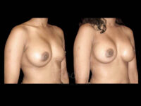 Breast Before After Photos Breast Implant Replacement Before After Photos Case #13629 - Pancholi Cosmetic Surgery