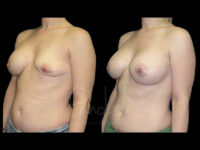 Breast Before After Photos Breast Implant Replacement Before After Photos Case #13631 - Pancholi Cosmetic Surgery