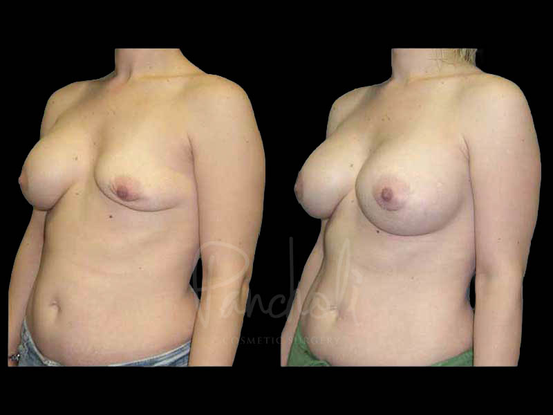 Breast Before After Photos Breast Implant Replacement Before After Photos Case #13631 - Pancholi Cosmetic Surgery