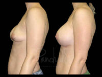Breast Before After Photos Breast Implant Replacement Before After Photos Case #13632 - Pancholi Cosmetic Surgery
