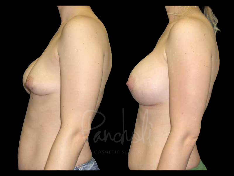 Breast Before After Photos Breast Implant Replacement Before After Photos Case #13632 - Pancholi Cosmetic Surgery