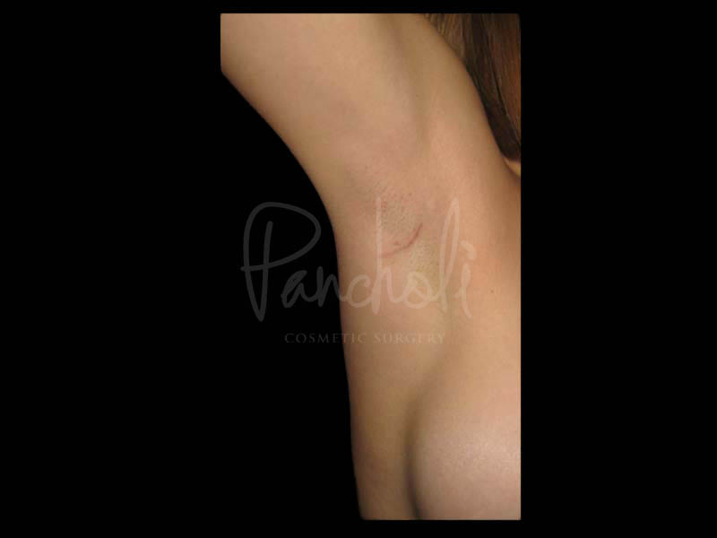 Breast Before After Photos Transaxillary Breast Augmentation Scar Before After Photos Case #13393 - Pancholi Cosmetic Surgery