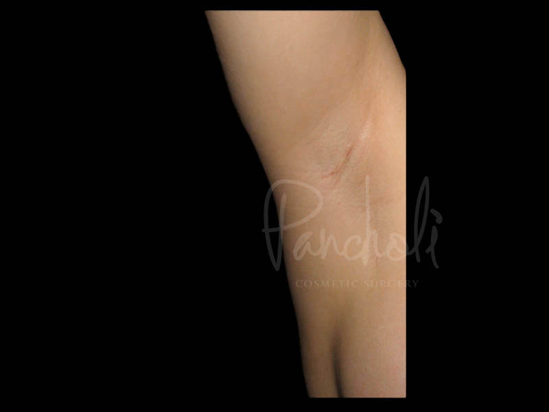 Breast Before After Photos Transaxillary Breast Augmentation Scar Before After Photos Case #13395 - Pancholi Cosmetic Surgery