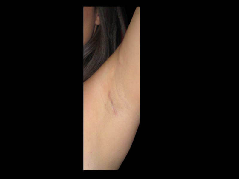 Breast Before After Photos Transaxillary Breast Augmentation Scar Before After Photos Case #13397 - Pancholi Cosmetic Surgery