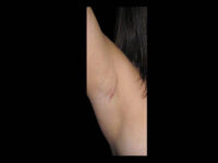 Breast Before After Photos Transaxillary Breast Augmentation Scar Before After Photos Case #13398 - Pancholi Cosmetic Surgery