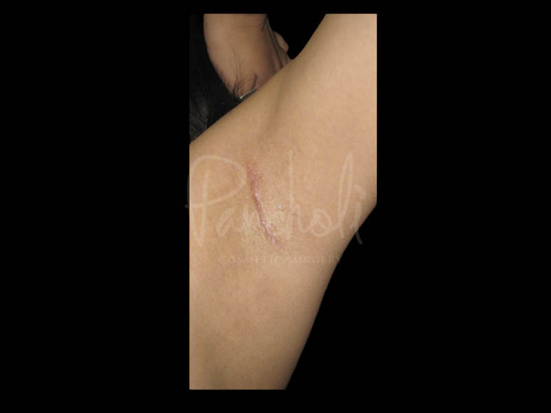 Breast Before After Photos Transaxillary Breast Augmentation Scar Before After Photos Case #13400 - Pancholi Cosmetic Surgery