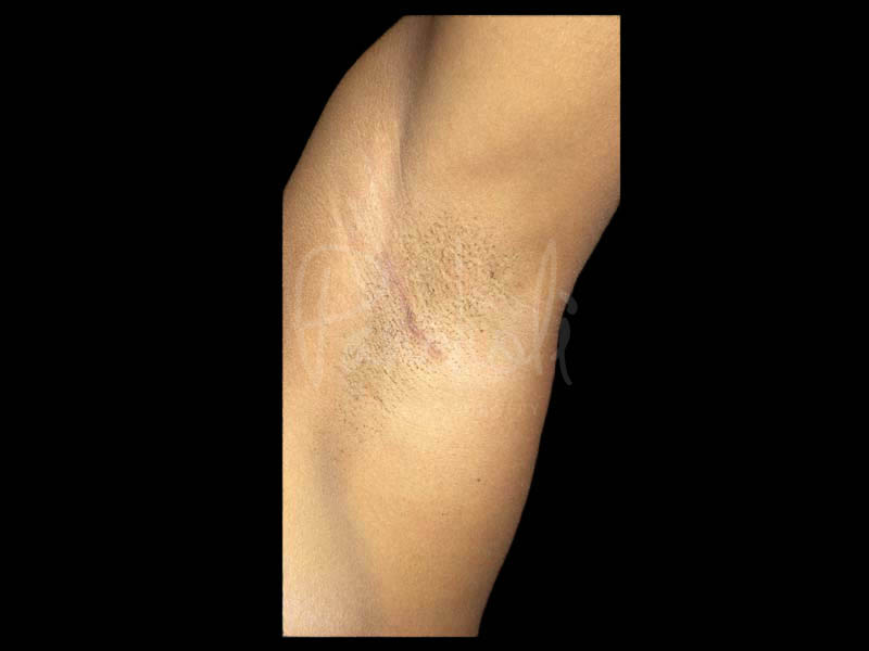 Breast Before After Photos Transaxillary Breast Augmentation Scar Before After Photos Case #13402 - Pancholi Cosmetic Surgery