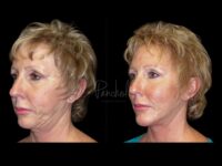 Face Before After Photos Facelift Before After Photos Case #13511 - Pancholi Cosmetic Surgery
