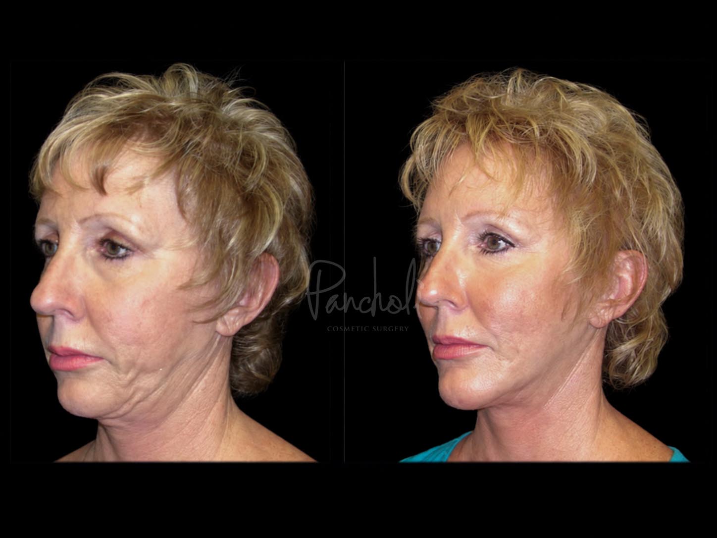 Face Before After Photos Facelift Before After Photos Case #13511 - Pancholi Cosmetic Surgery