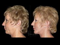 Face Before After Photos Facelift Before After Photos Case #13512 - Pancholi Cosmetic Surgery