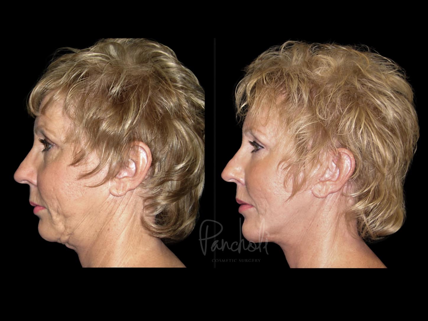 Face Before After Photos Facelift Before After Photos Case #13512 - Pancholi Cosmetic Surgery