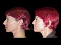 Face Before After Photos Rhinoplasty Before After Photos Case #13514 - Pancholi Cosmetic Surgery