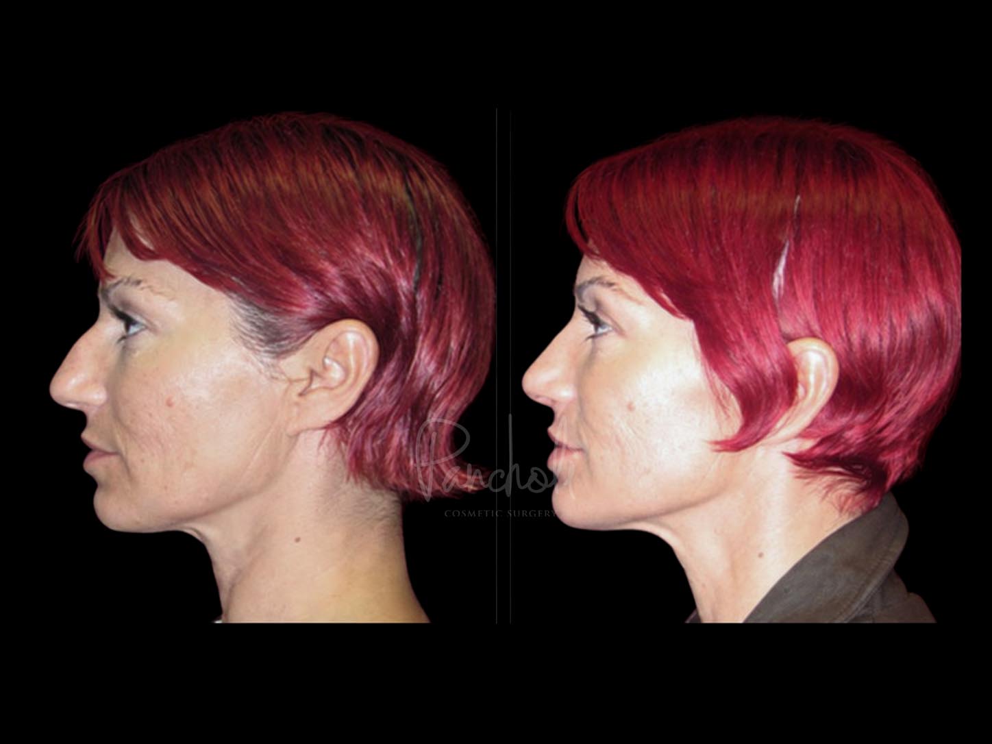 Face Before After Photos Rhinoplasty Before After Photos Case #13514 - Pancholi Cosmetic Surgery