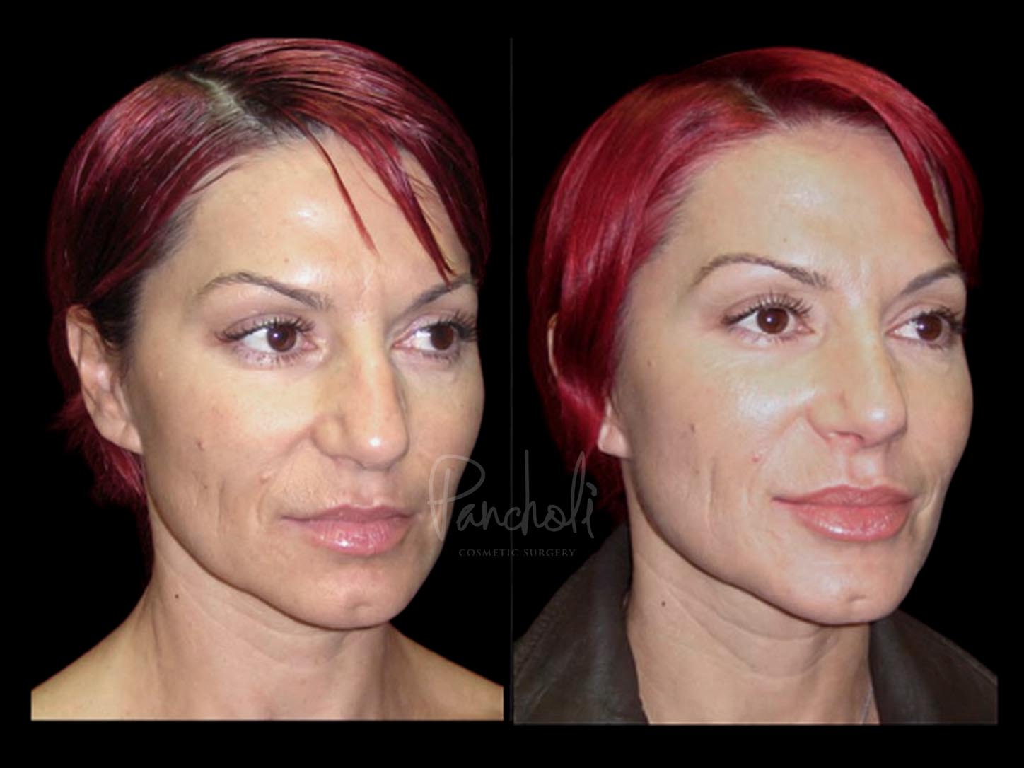Face Before After Photos Rhinoplasty Before After Photos Case #13515 - Pancholi Cosmetic Surgery