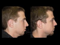 Face Before After Photos Rhinoplasty Before After Photos Case #13524 - Pancholi Cosmetic Surgery