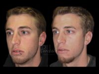 Face Before After Photos Rhinoplasty Before After Photos Case #13525 - Pancholi Cosmetic Surgery