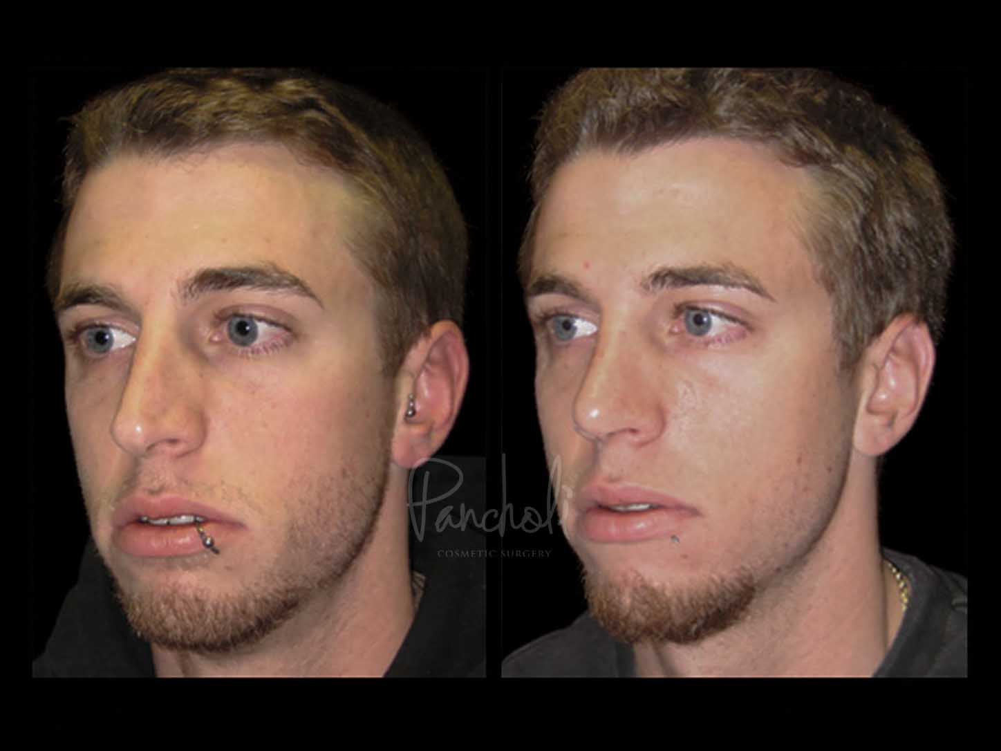 Face Before After Photos Rhinoplasty Before After Photos Case #13525 - Pancholi Cosmetic Surgery